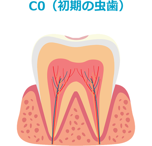C0（初期の虫歯）