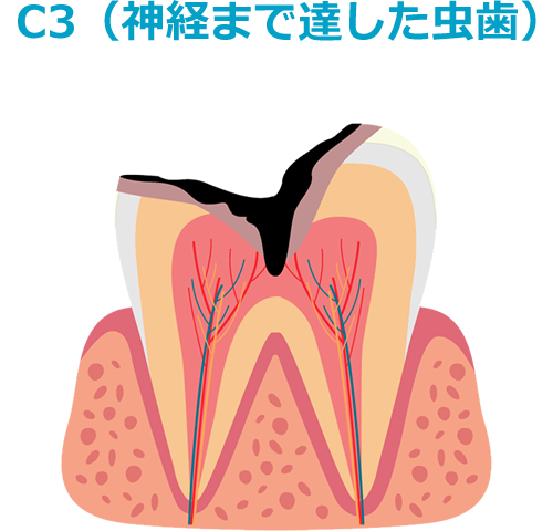 C3（神経まで達した虫歯）