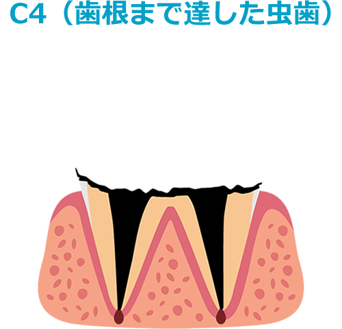 C4（歯根まで達した虫歯）